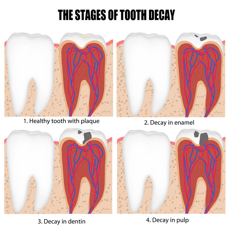 How fast can a tooth decay? - Dr. Karen Kang, DDS - Ebenezer Dental ...