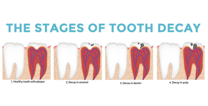 How fast can a tooth decay? - Dr. Karen Kang, DDS - Ebenezer Dental ...