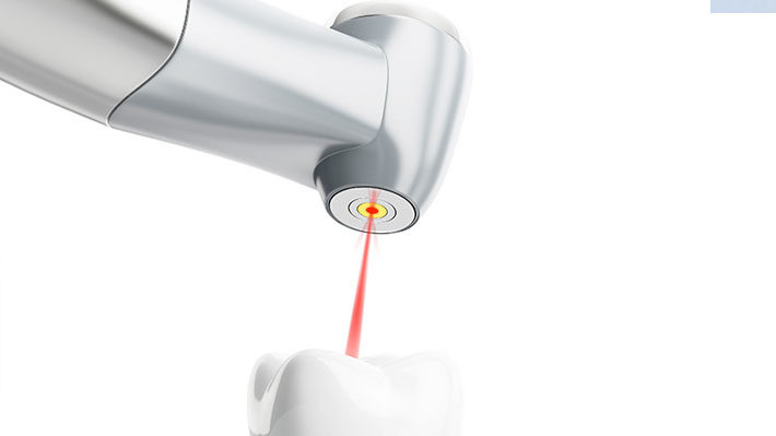 Root Canal Laser Technology